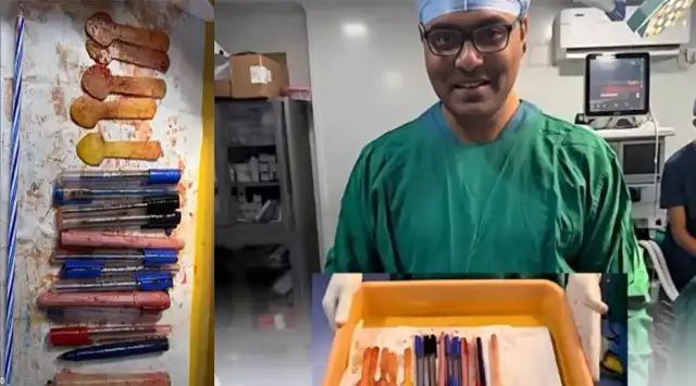 അസഹ്യമായ വയറുവേദന; ആശുപത്രിയിലെത്തിയ യുവതിയുടെ വയറ്റില്നിന്ന് ഡോക്ടര്മാര് പുറത്തെടുത്തത് 14 പേനകളും അഞ്ച് സ്പൂണുകളും ഒരു മെഴുകുതിരിയും അസഹ്യമായ വയറുവേദന; ആശുപത്രിയിലെത്തിയ യുവതിയുടെ വയറ്റില്നിന്ന് ഡോക്ടര്മാര് പുറത്തെടുത്തത് 14 പേനകളും അഞ്ച് സ്പൂണുകളും ഒരു മെഴുകുതിരിയും